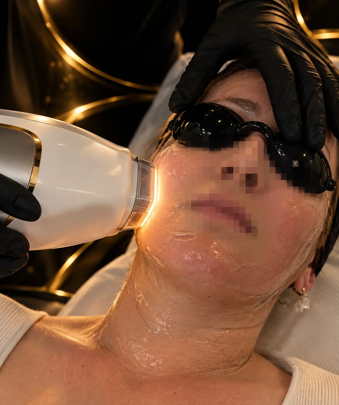 Sesión de luz pulsada intensa (IPL) facial