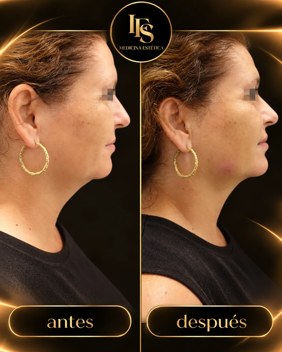 Resultado real de Armonización facial en IFS Medicina Estética: antes y después