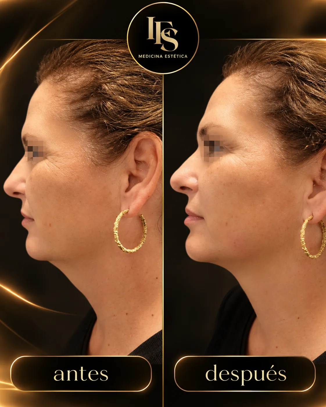 Resultado real de Armonización facial en IFS Medicina Estética: antes y después