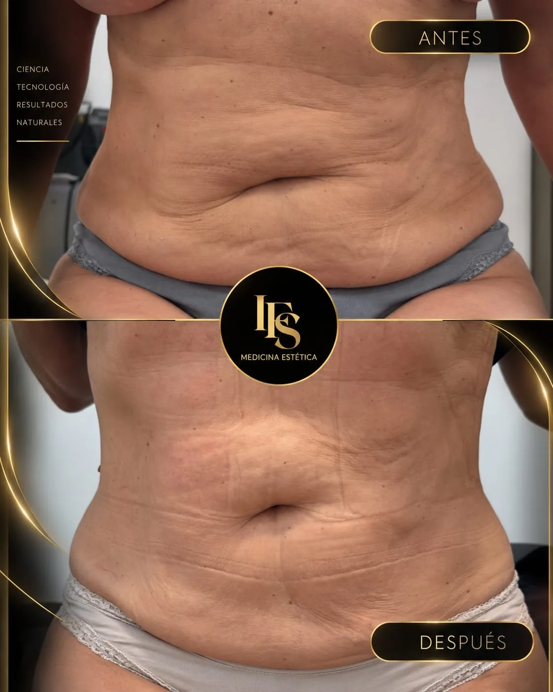 Resultado real de Remodelación corporal en IFS Medicina Estética: antes y después