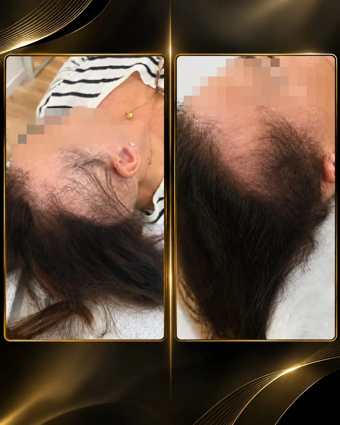 Resultado real de Medicina capilar en IFS Medicina Estética: antes y después