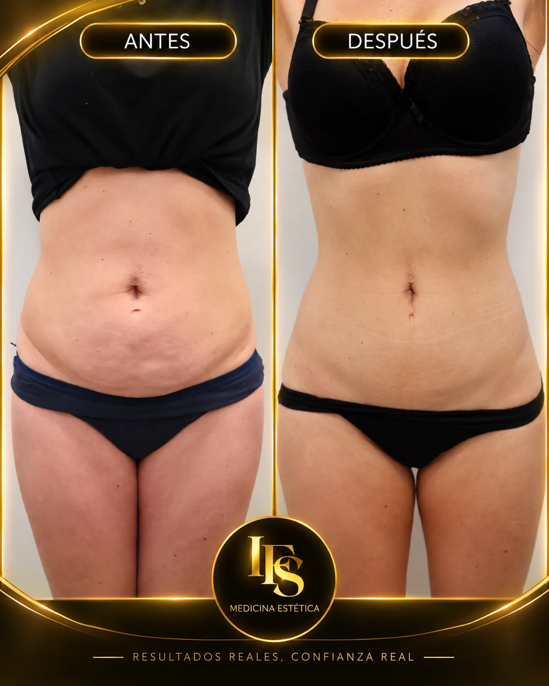 Resultado real de Endoláser · abdomen y flancos en IFS Medicina Estética: antes y después