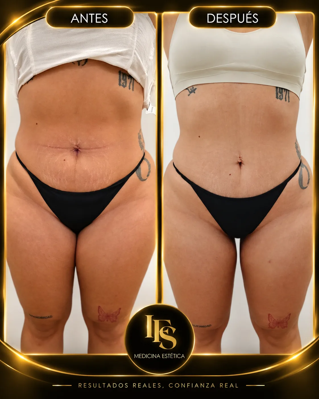 Resultado real de Abdomen en IFS Medicina Estética: antes y después