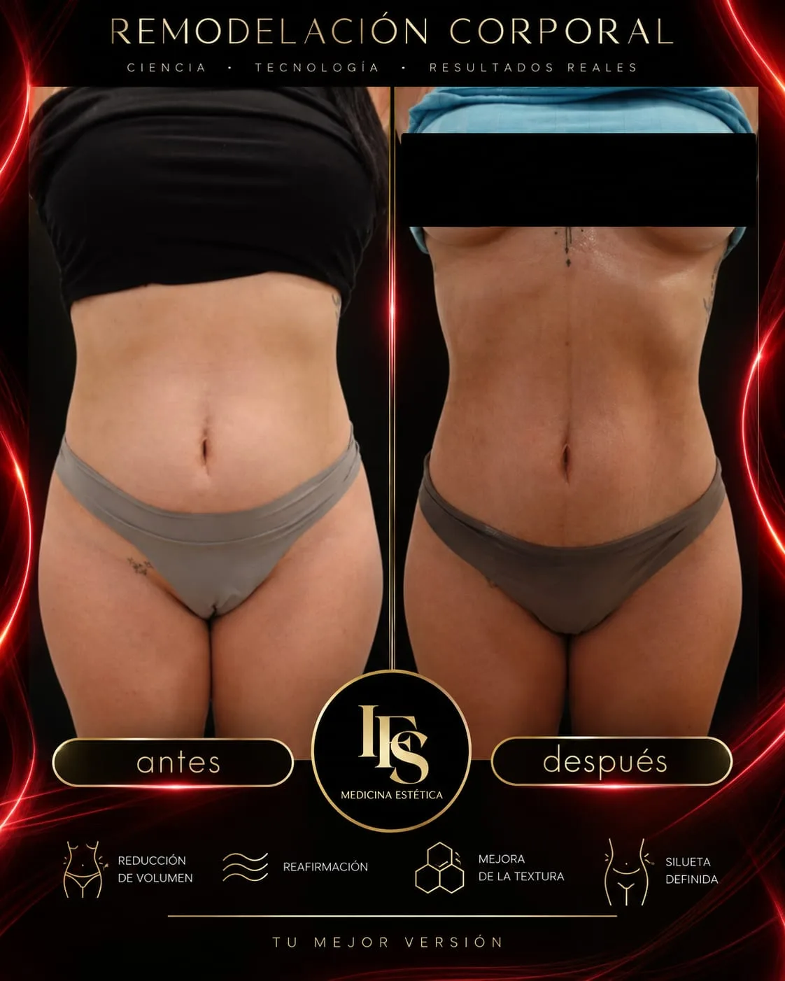 Resultado real de Remodelación corporal en IFS Medicina Estética: antes y después