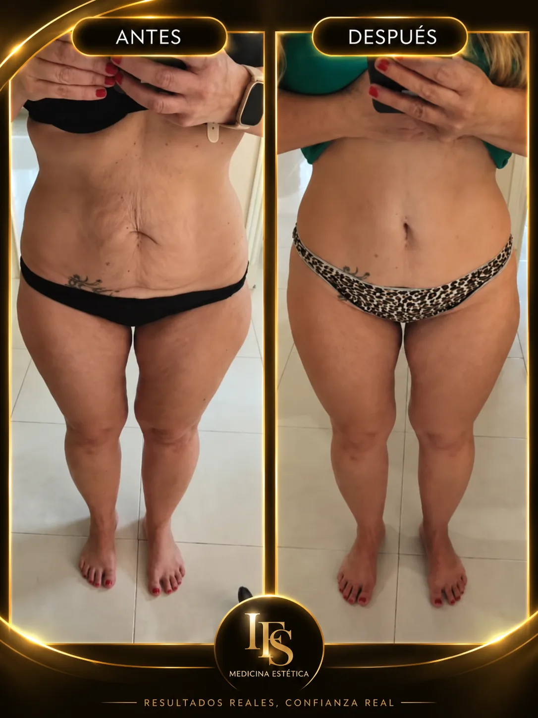 Resultado real de Abdomen y muslos en IFS Medicina Estética: antes y después