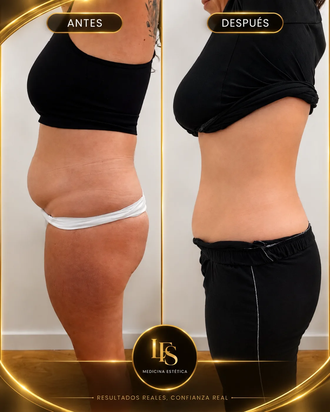 Resultado real de Abdomen, perfil en IFS Medicina Estética: antes y después