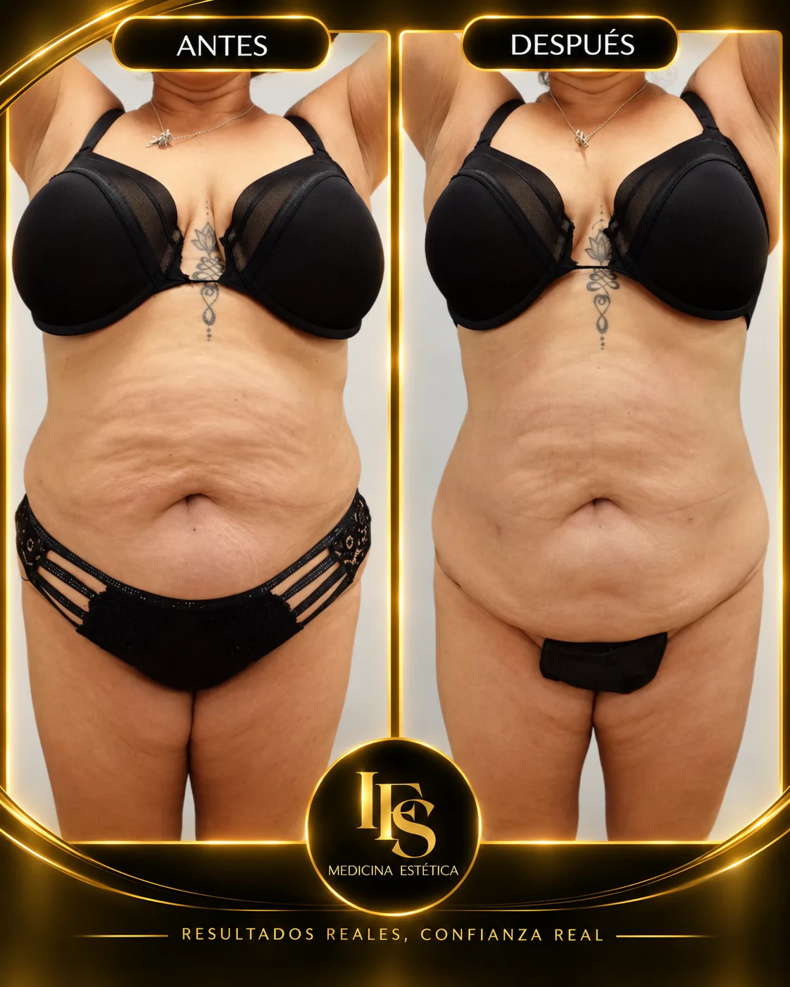 Resultado real de Abdomen y cintura en IFS Medicina Estética: antes y después