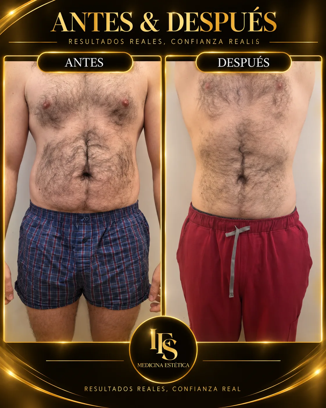 Resultado real de Abdomen masculino en IFS Medicina Estética: antes y después