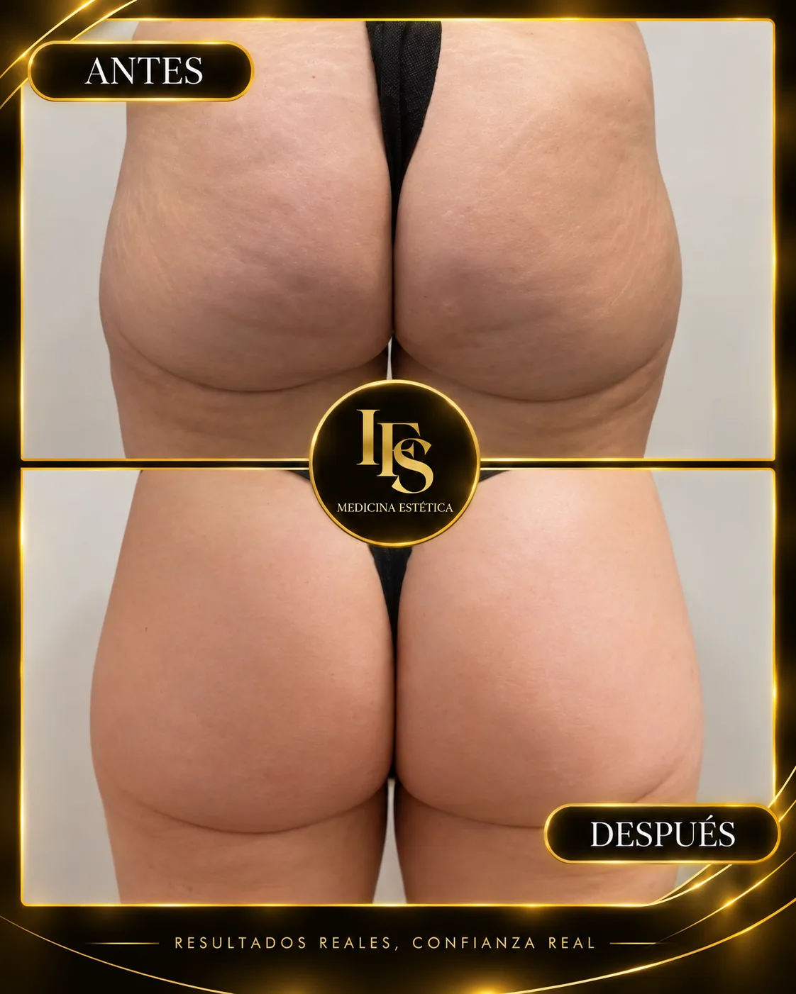 Resultado real de Glúteos y cartucheras en IFS Medicina Estética: antes y después
