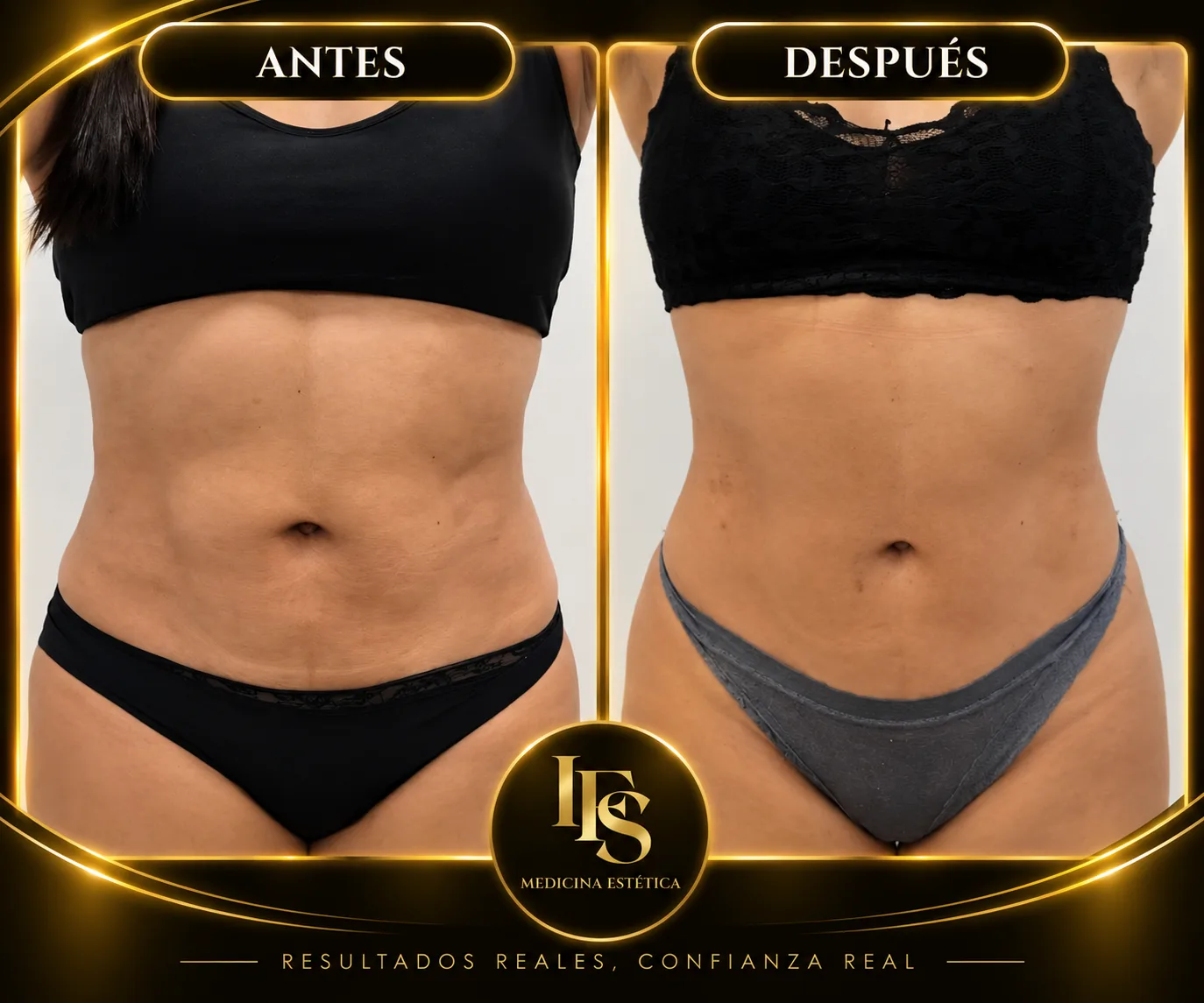Resultado real de Abdomen y cintura en IFS Medicina Estética: antes y después