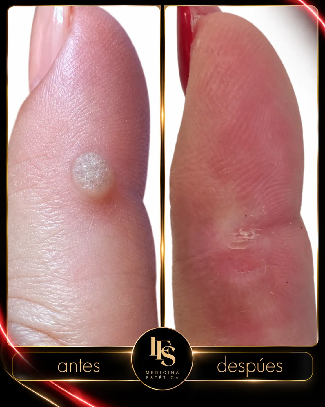 Resultado real de Eliminación de lesiones con láser en IFS Medicina Estética: antes y después