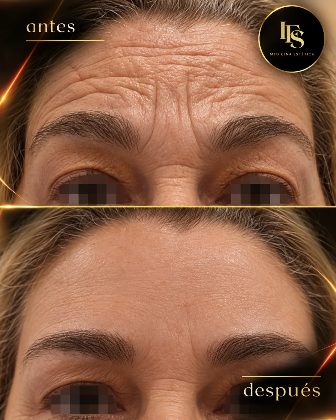Resultado real de Neuromoduladores · frente en IFS Medicina Estética: antes y después