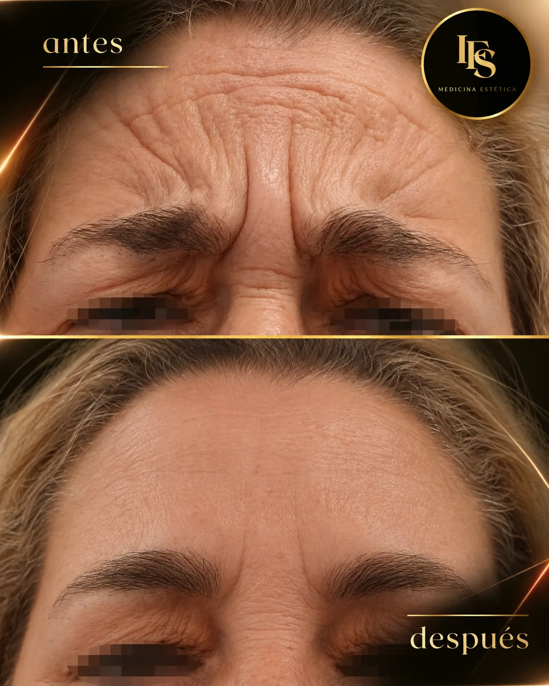 Resultado real de Neuromoduladores · tercio superior en IFS Medicina Estética: antes y después