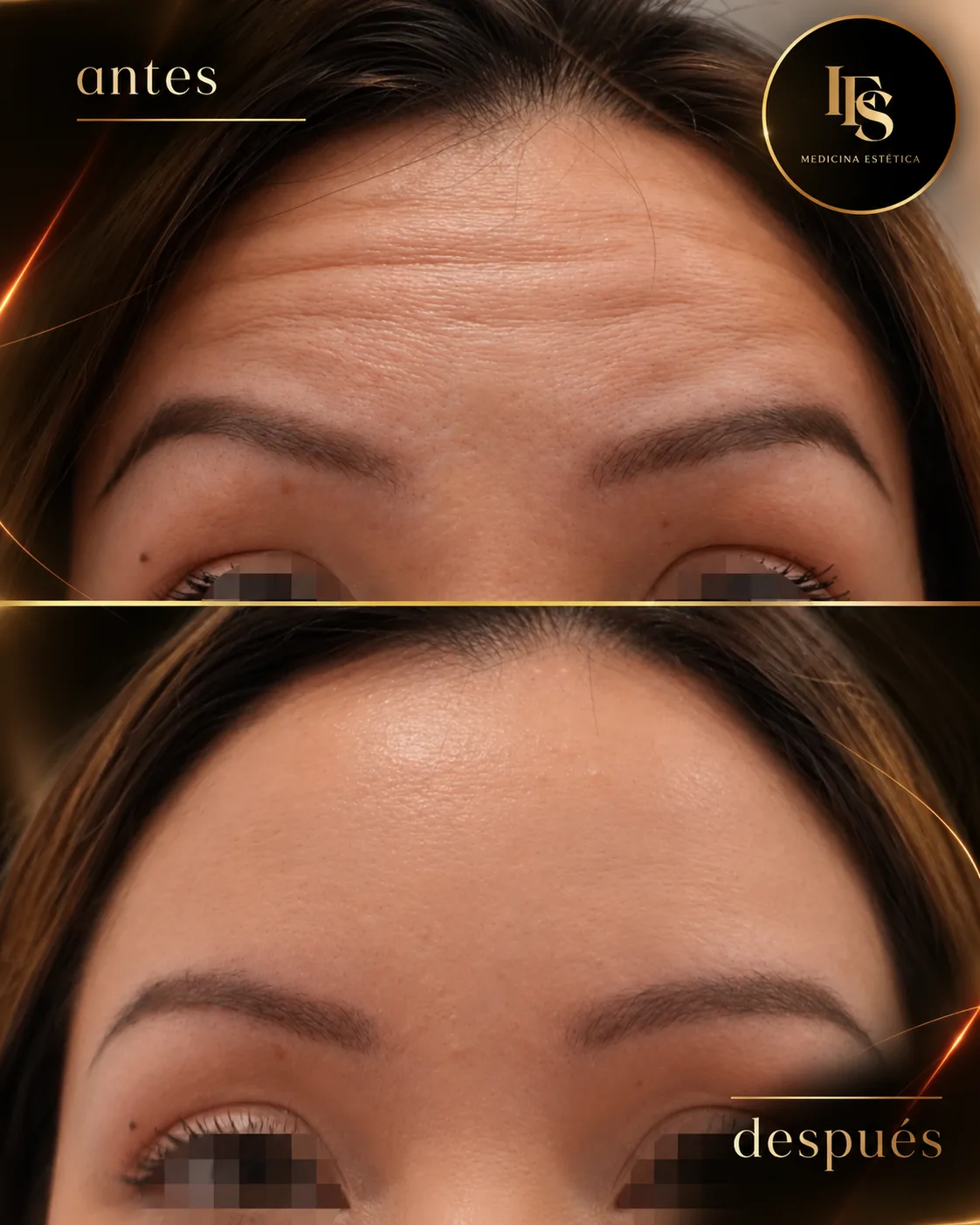 Resultado real de Neuromoduladores · mirada en IFS Medicina Estética: antes y después
