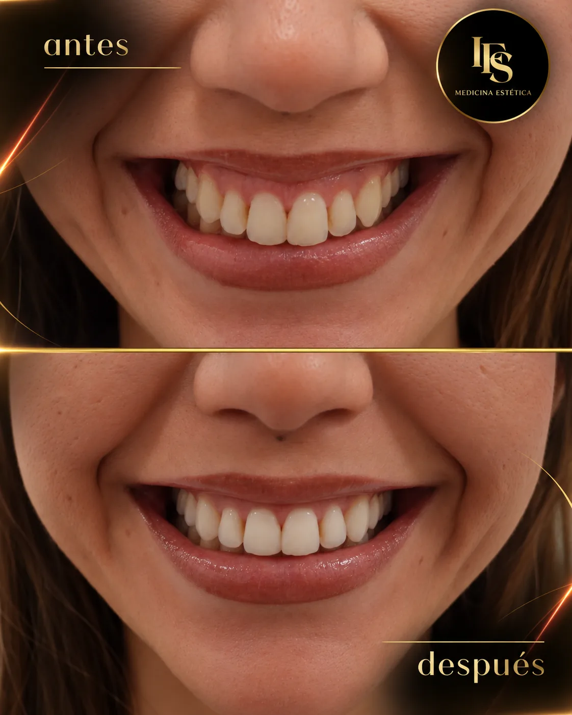 Resultado real de Corrección de sonrisa gingival en IFS Medicina Estética: antes y después